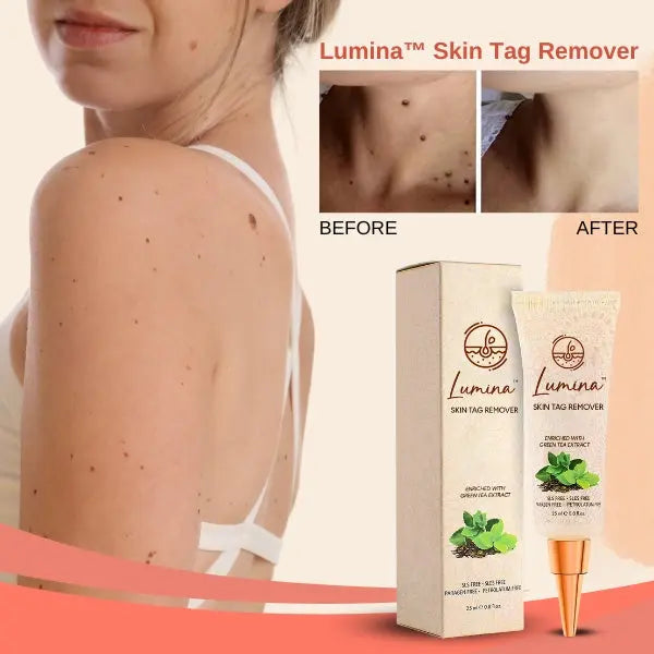 Lumina™ Skin Tag Remover - EVERRD USA