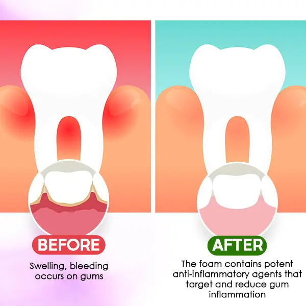DentiCare™ Gum Treatment Foam - EVERRD USA